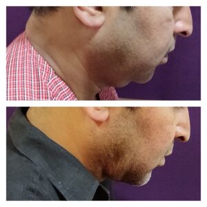 Double Chin Removal Treatment 6 Double Chin Treatment at The Venkat Center