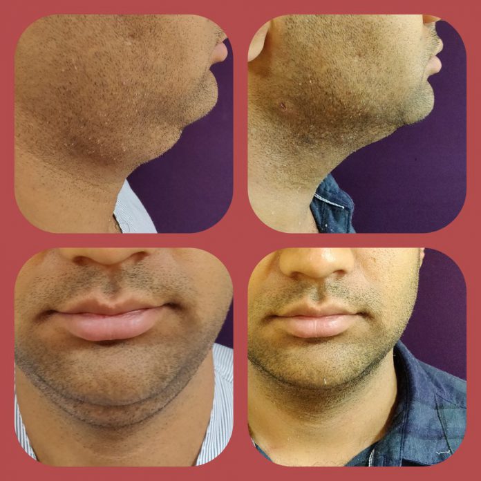 Double Chin removal Treatment at The Venkat Center