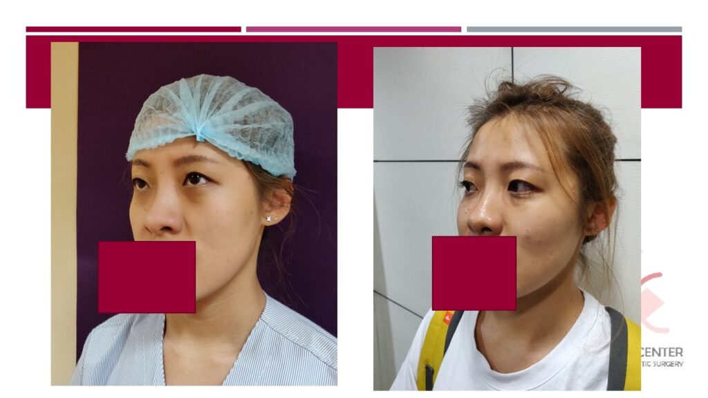 Fat grafting for cheek augmentation at Venkat Center, Bangalore