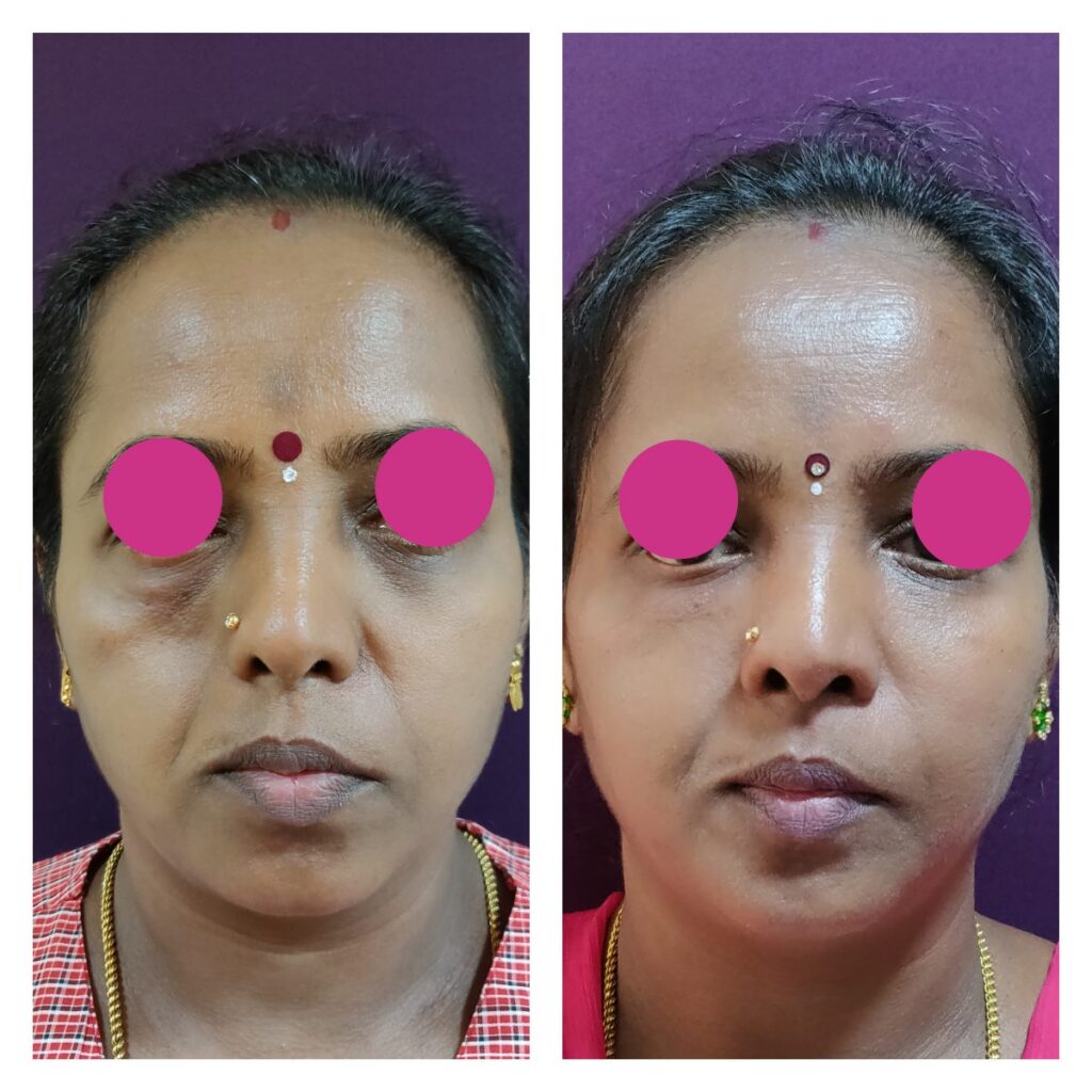 Fat grafting for facial defect at Venkat Center