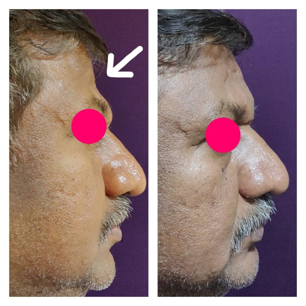 Fat Grafting Nano Fat Results- at Venkat Center, Bangalore