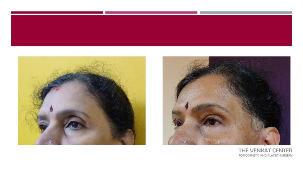 Fat grafting for upper eyelid hollowness