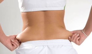 liposuction in abdomen