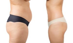 What is Liposuction Surgery