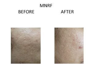 Laser Scar Removal - at Venkat Center, Bangalore