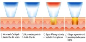 Micro Needling Radio Frequency process