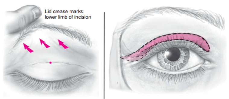 Making the Blepharoplasty Incision