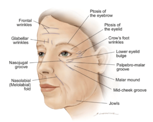 Signs-of-facial-ageing