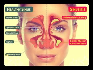 Sinusitis treatment at The Venkat Center, Bangalore