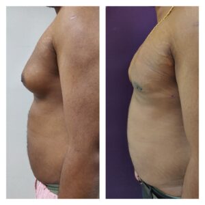 Gynaecomastia Treatment at Venkat Center