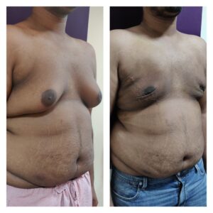 Gynaecomastia Treatment at Venkat Center