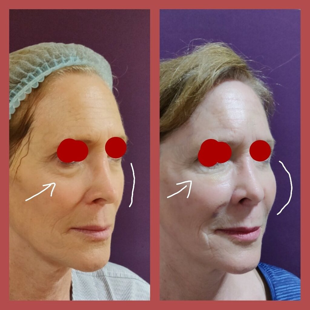 Undereye and Cheek Augmentation at Venkat Center, Bangalore