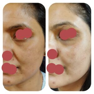 Undereye cheek and nasolabial fat grafting