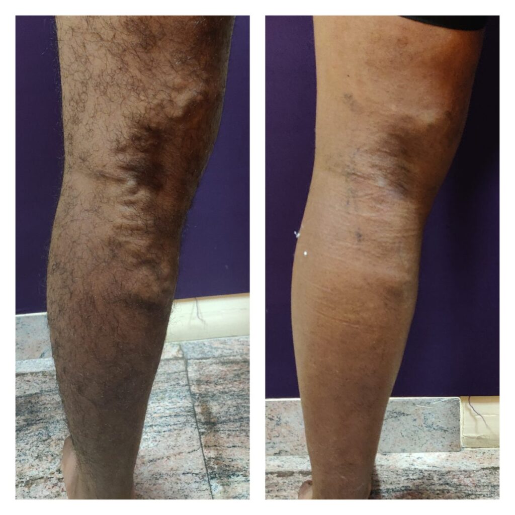 Varicose Veins Surgery Cost