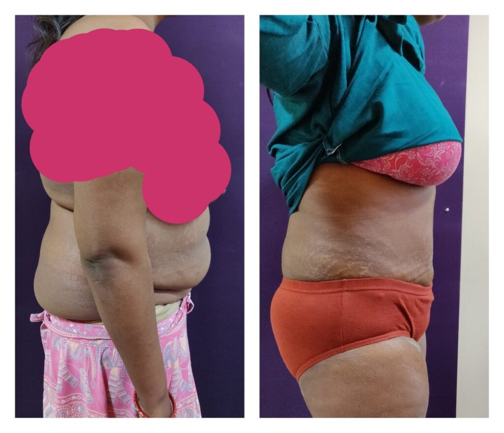 Tummy Tuck Cost In Bangalore- Abdominoplasty