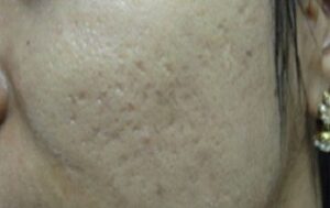 acne scars treatment