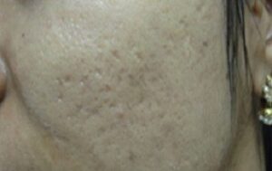 acne scars treatment