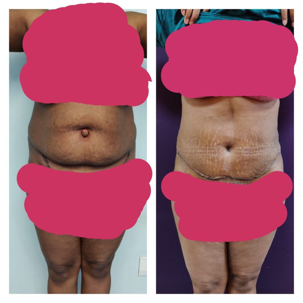 Best Abdominoplasty in Bangalore