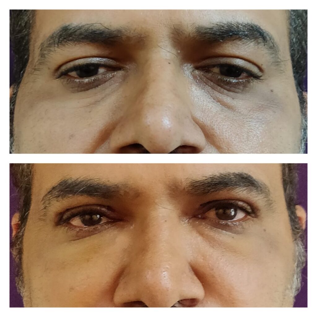 blepharoplasty cost in india