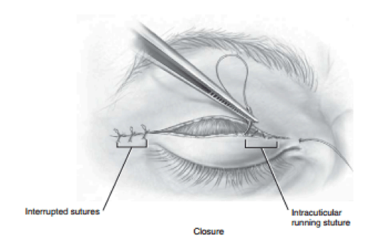 Blepharoplasty 