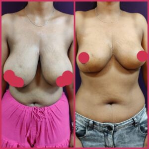 breast augmentation at The Venkat Center