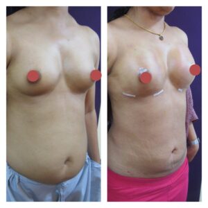 breast augmentation at The Venkat Center