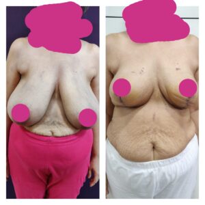 breast augmentation at The Venkat Center