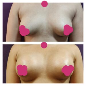 breast augmentation at The Venkat Center