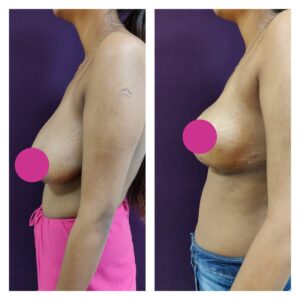 breast augmentation at The Venkat Center