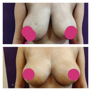 breast augmentation at The Venkat Center