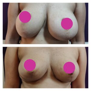 breast augmentation at The Venkat Center