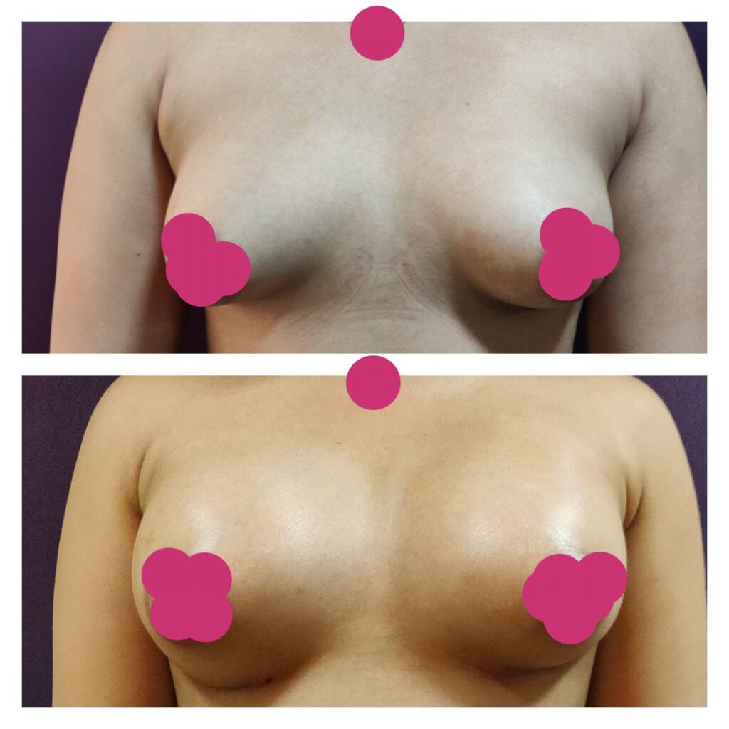 Breast augmentation via implants- before and after