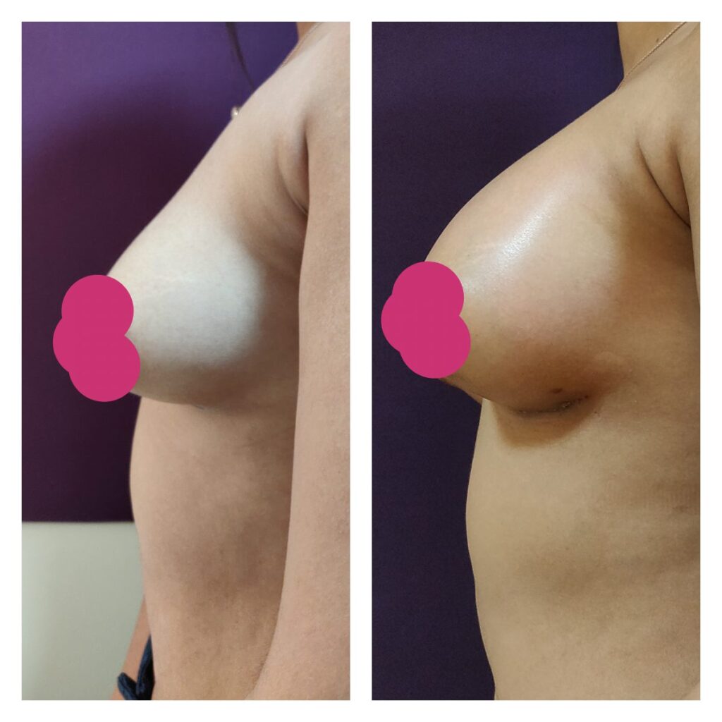 Breast augmentation- before and after