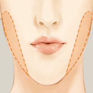 buccal-fat-pad-removal