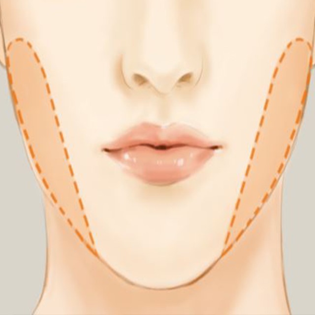 buccal fat pad removal