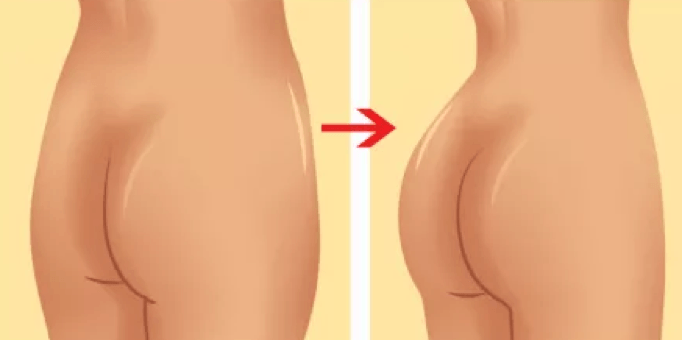 butt augmentation in bangalore