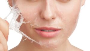 chemical peeling on face - chemical treatment