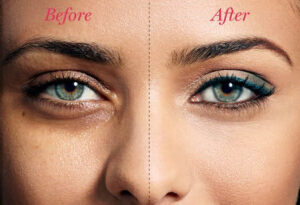 dark circle treatment in bangalore