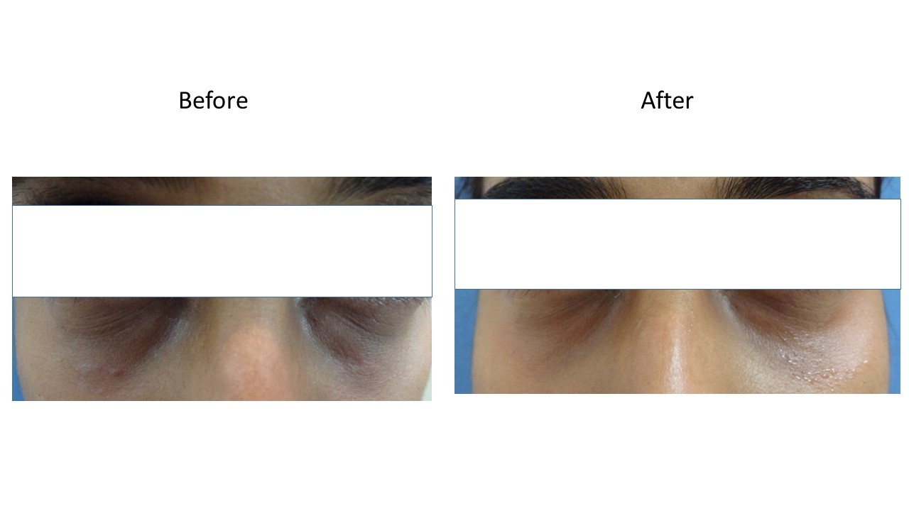 Dermal filler - at Venkat Center, Bangalore