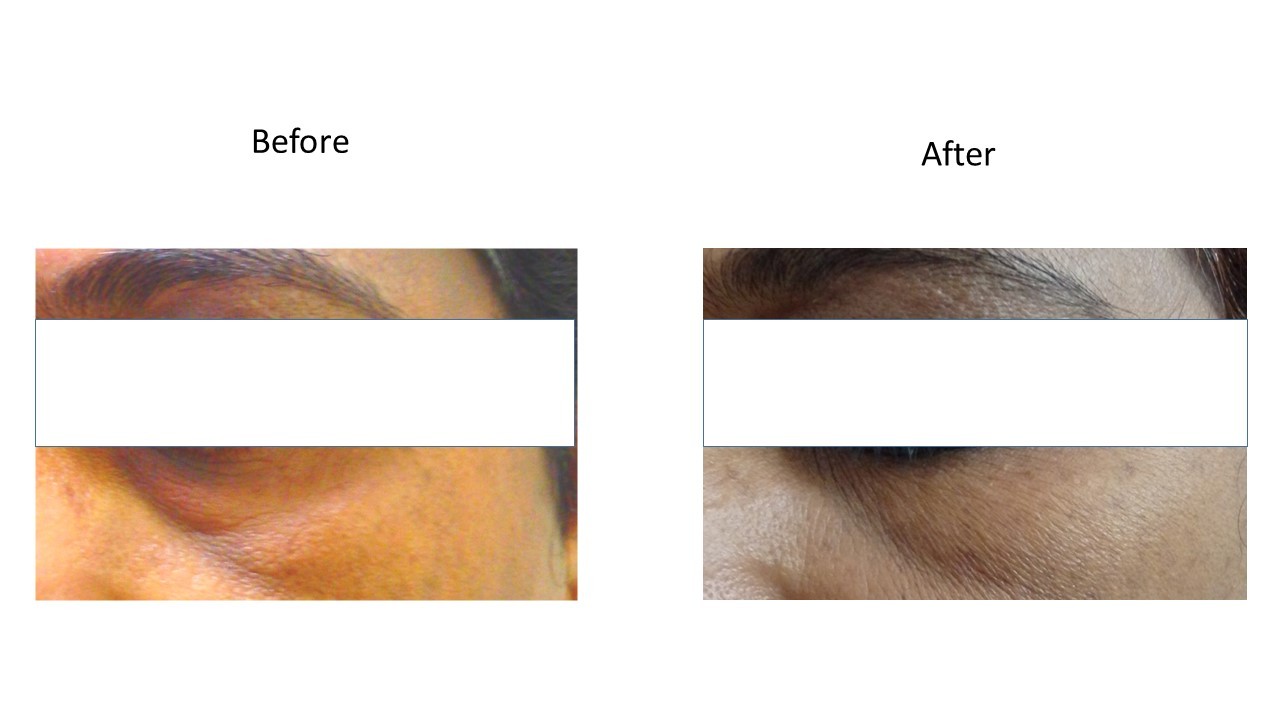 Dermal filler - at Venkat Center, Bangalore