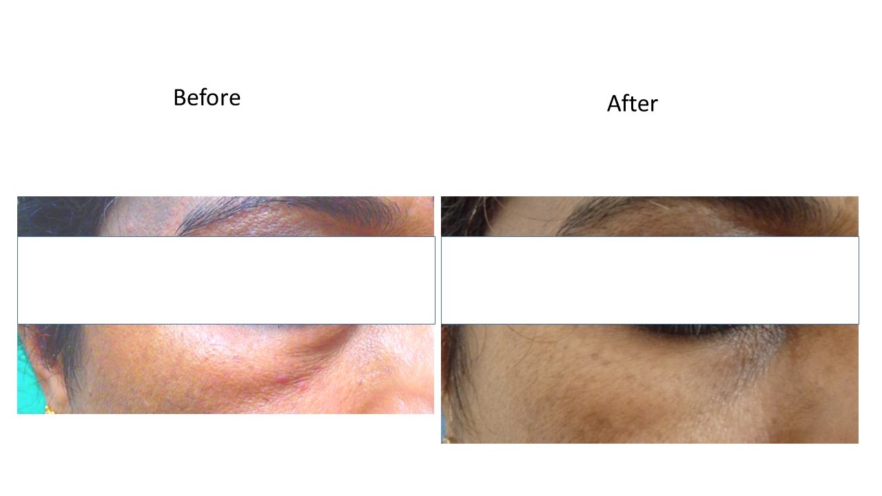 Dermal filler - at Venkat Center, Bangalore