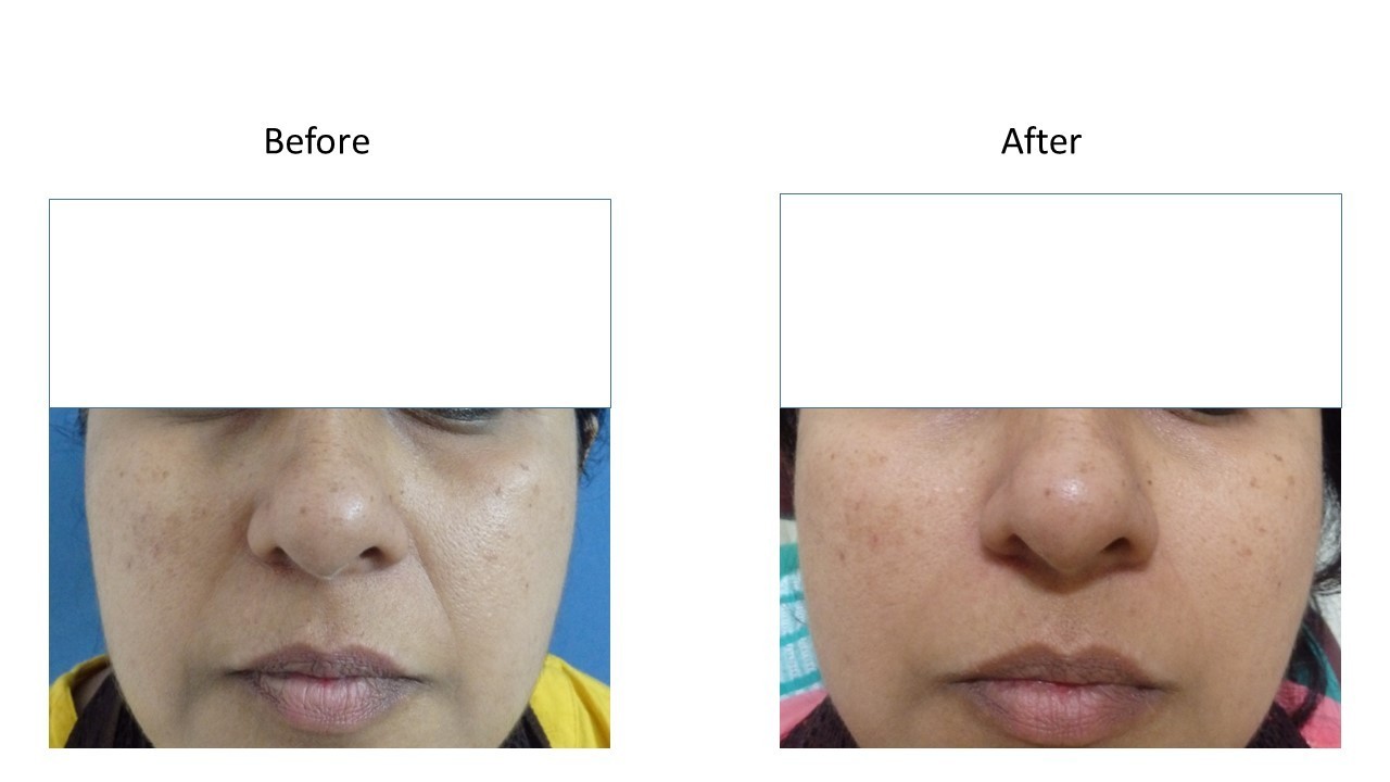 Dermal filler - at Venkat Center, Bangalore