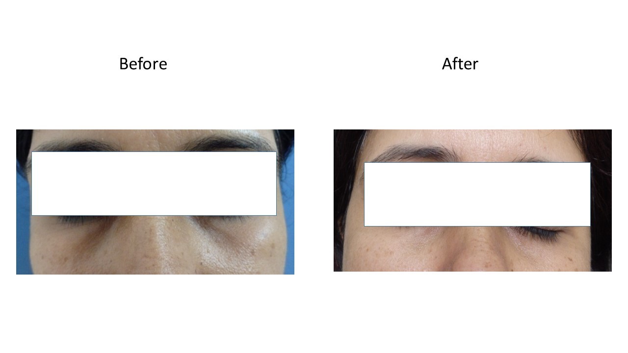 Dermal filler - at Venkat Center, Bangalore