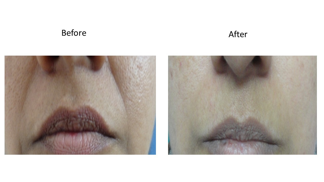 Dermal filler - at Venkat Center, Bangalore