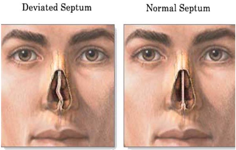 deviated septum nose job price