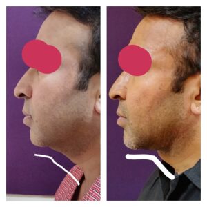 Double Chin Treatment at The Venkat Center