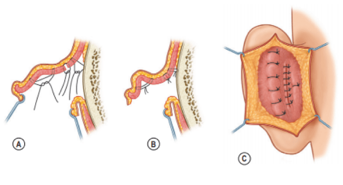 ear surgery cost