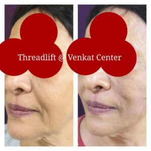 facial rejuvenation treatment at The Venkat Center