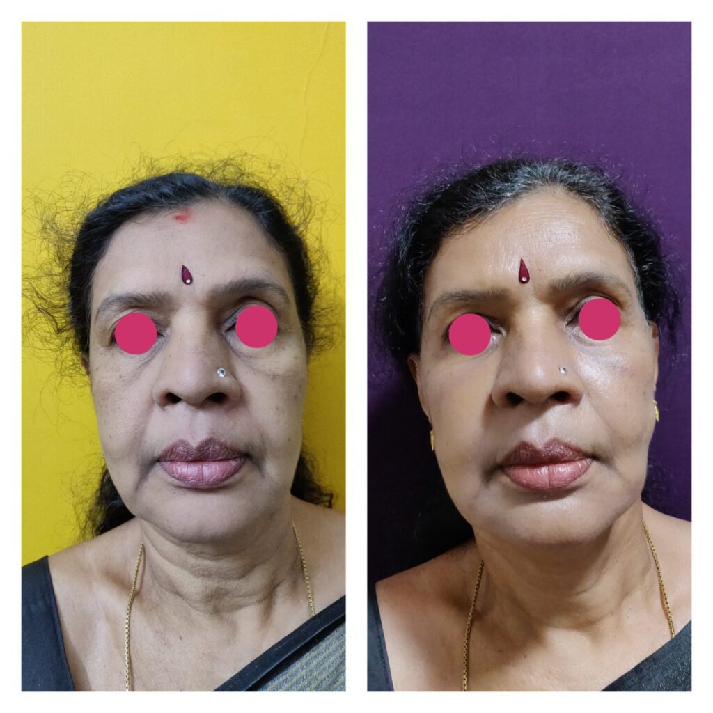 Facelift In India  Necklift Facelift Surgery- Venkat Center