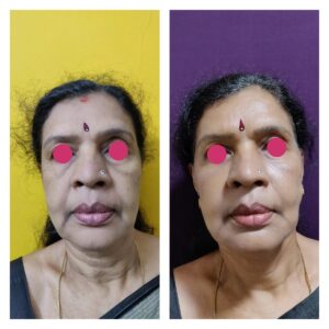 facial rejuvenation treatment at The Venkat Center